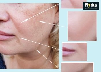 Pigmentation Treatment in MSR Layout