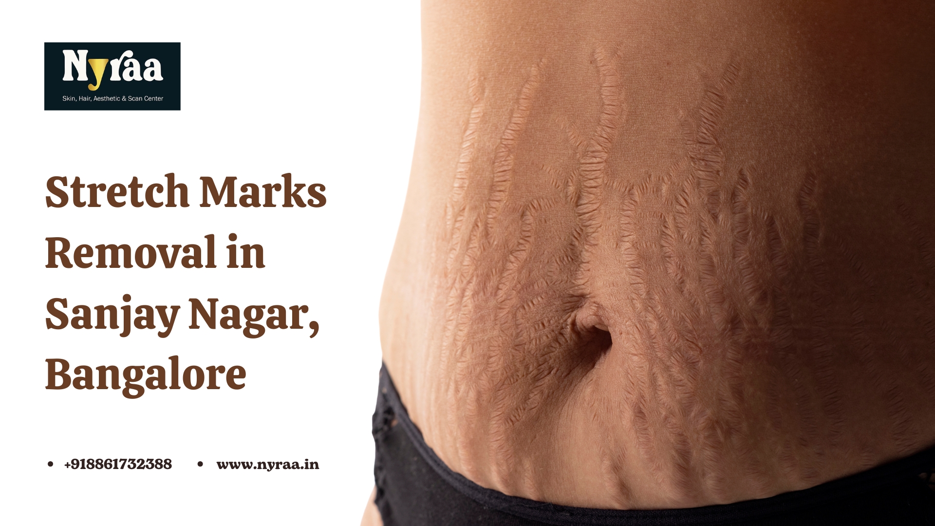 Stretch Marks Removal in Sanjay Nagar Bangalore
