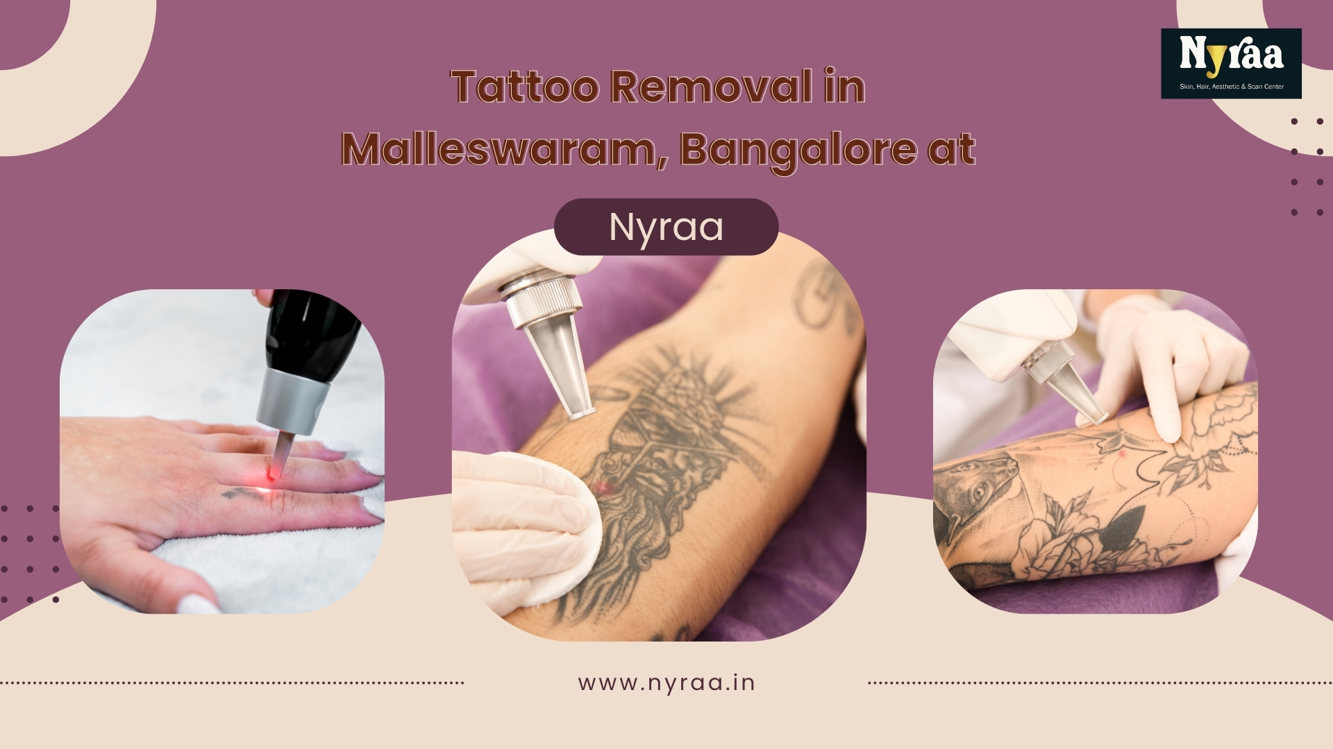Laser Tattoo Removal in Malleswaram Bangalore