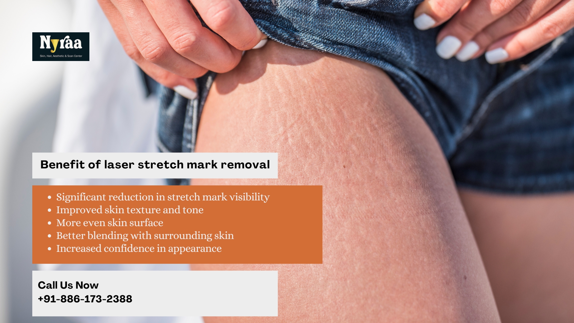 Stretch Marks Removal in Malleswaram