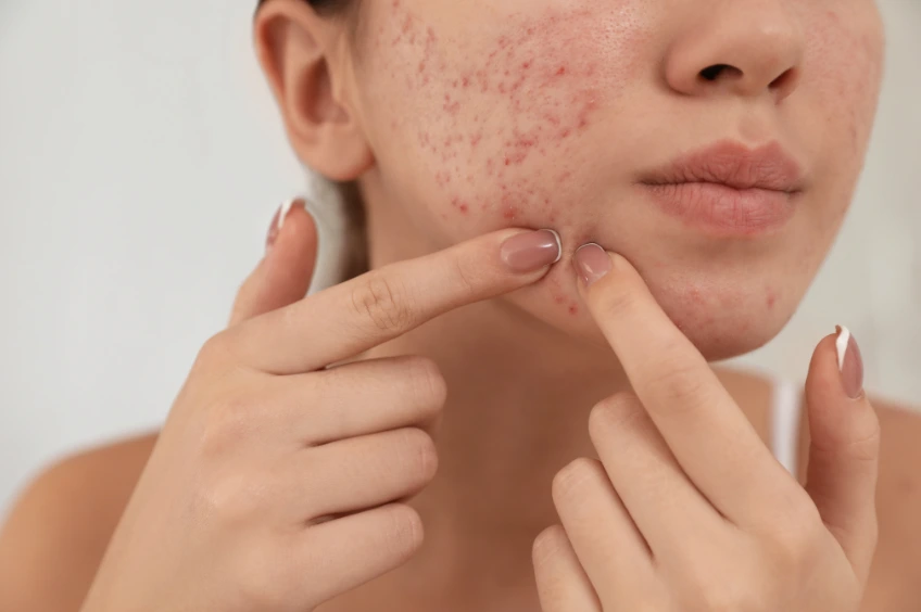 Top Effective Acne Treatment Options in Bangalore