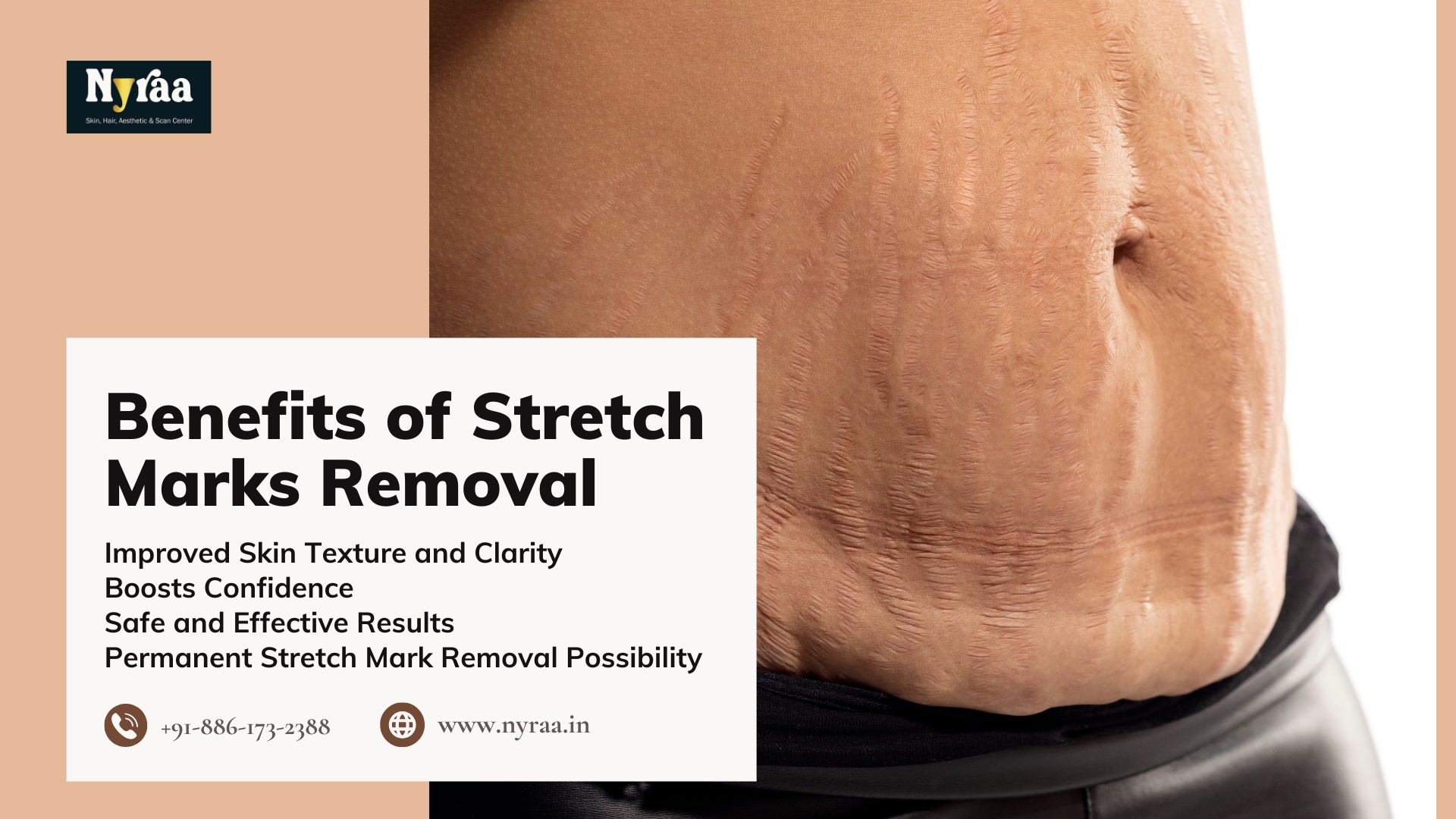 Stretch Marks Removal in New BEL Road