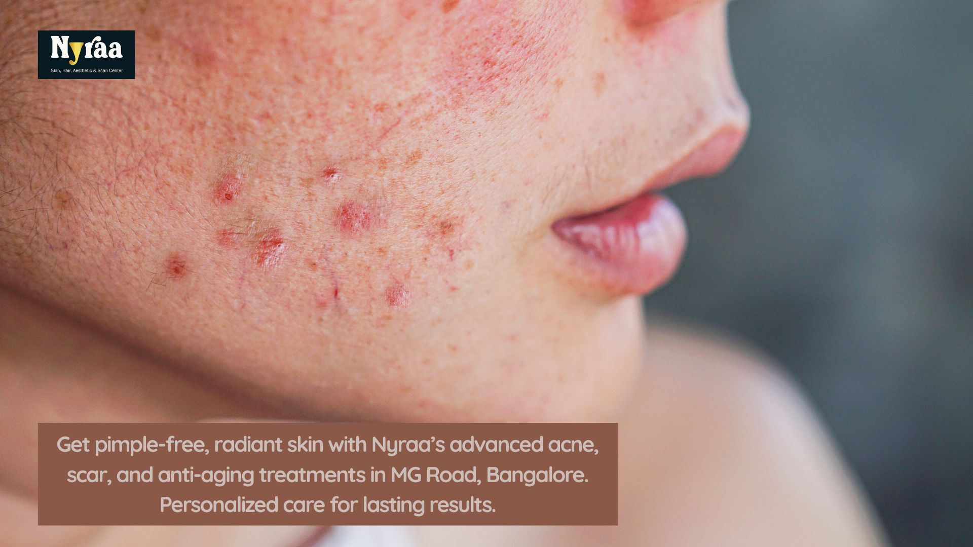 Acne Treatment in MG Road for Pimple Free Skin