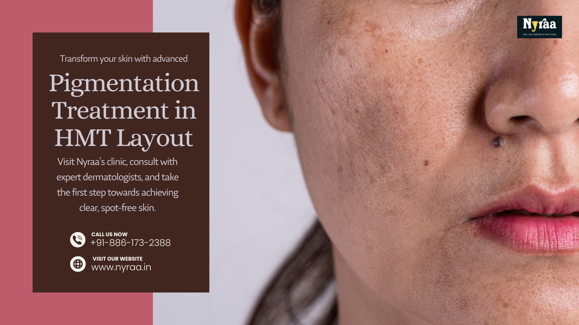 Pigmentation Treatment in HMT Layout