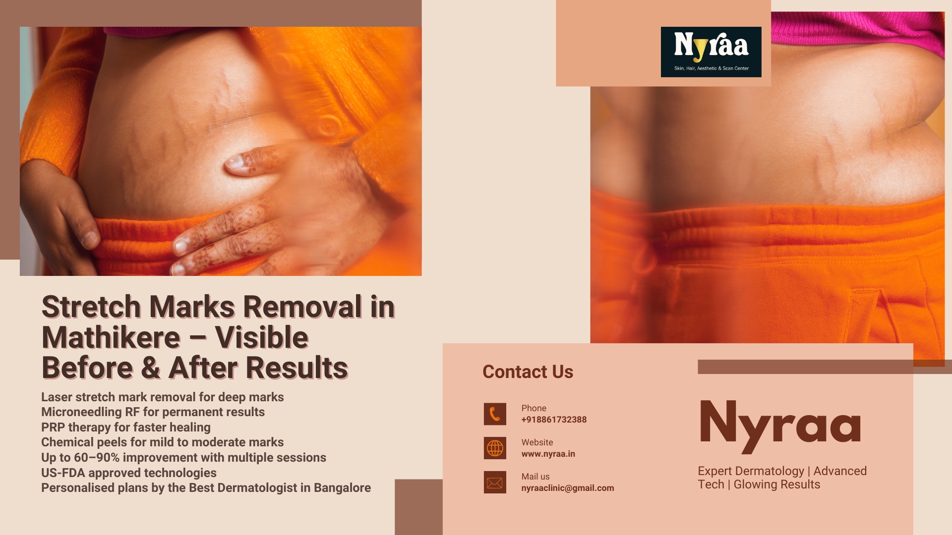 Stretch Marks Removal in Mathikere Bangalore