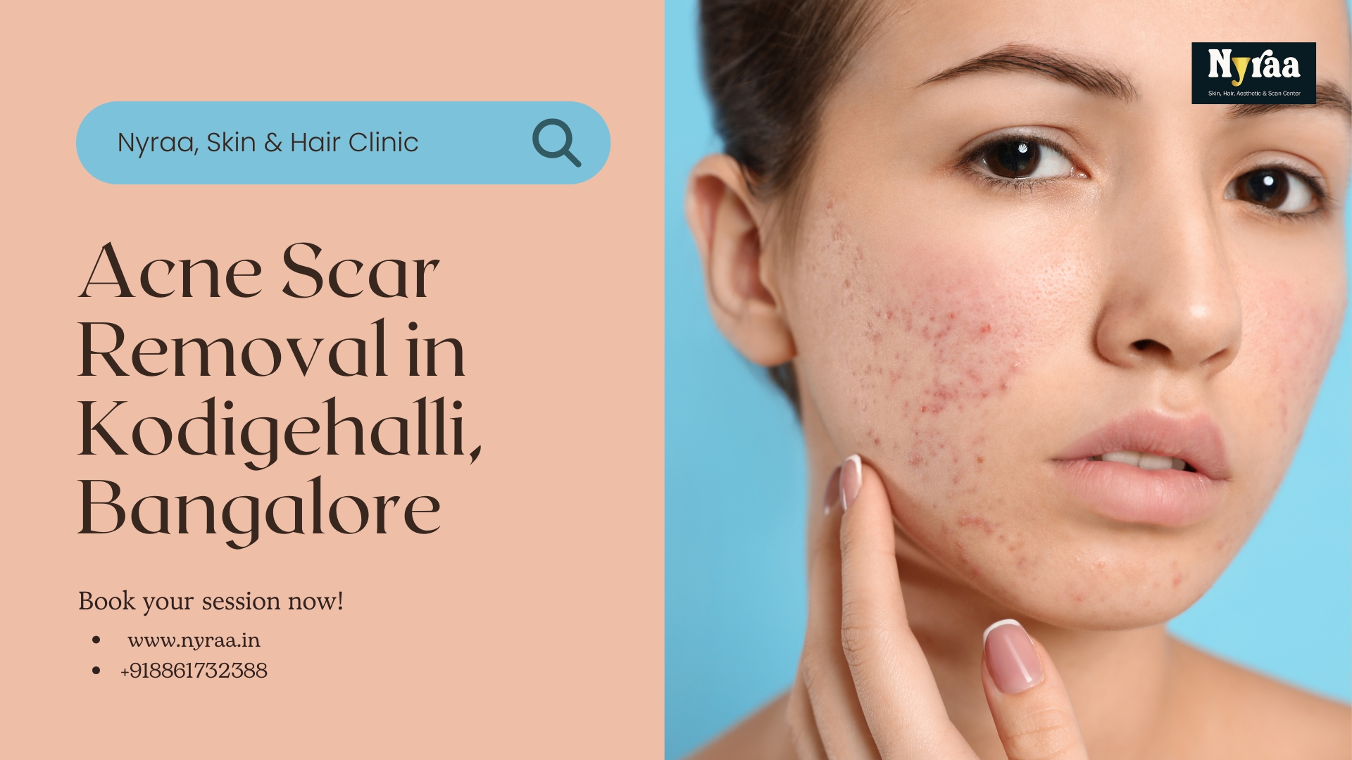 Acne Scar Removal in Kodigehalli Bangalore