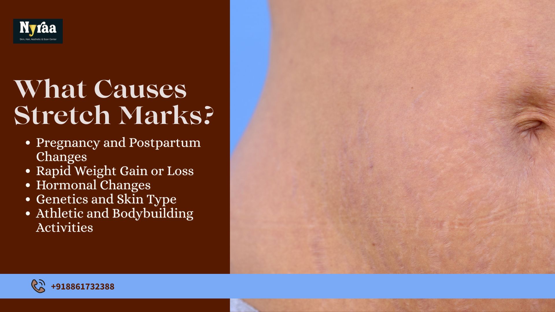 Stretch Mark Removal in Hebbal