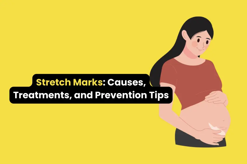 Stretch Marks Causes Treatments and Prevention Tips