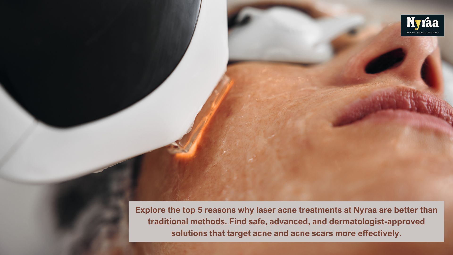 Top  Reasons to Choose Laser Acne Treatments Over Traditional Methods