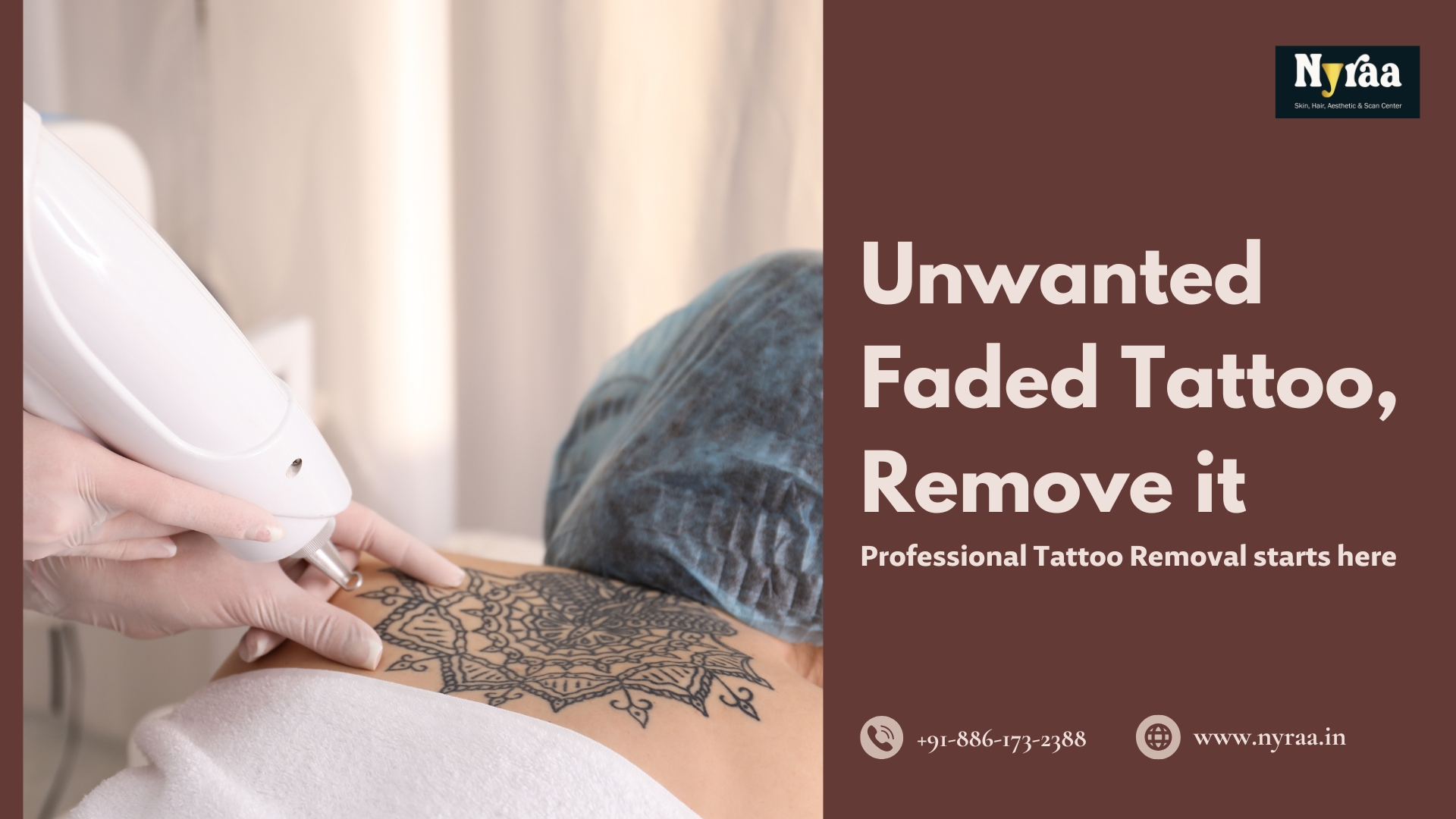 Tattoo Removal in HMT Layout Bangalore