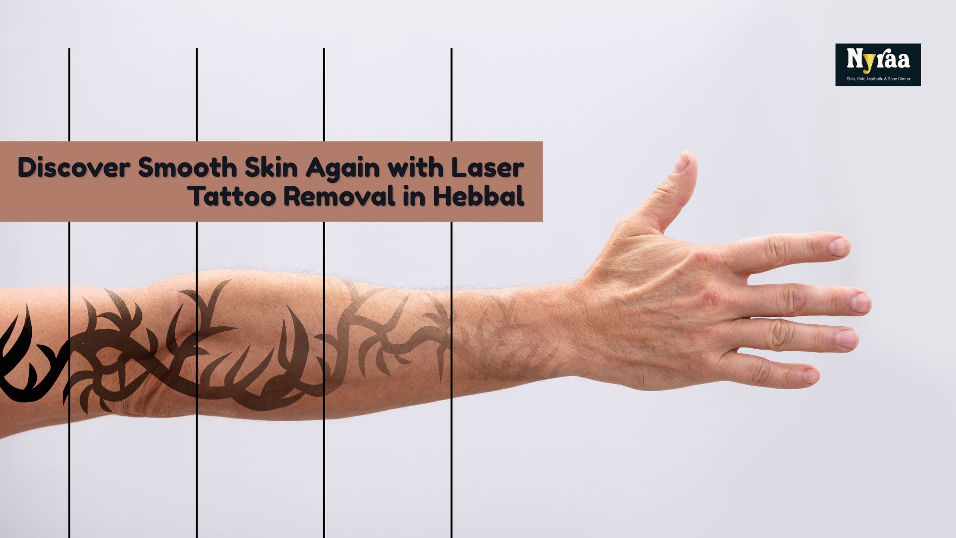 Laser Tattoo Removal in Hebbal