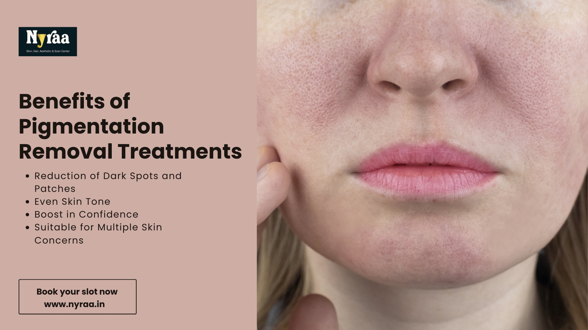 Pigmentation Treatment in Hebbal