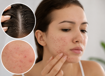 Acne Due to Dandruff Can Dandruff Cause Acne Expert Acne Care Solutions from an Acne Dermatologist