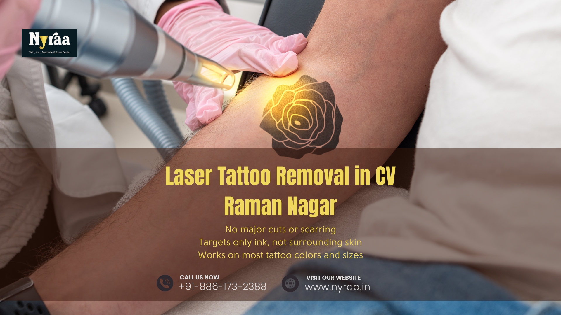 Laser Tattoo Removal in CV Raman Nagar Bangalore