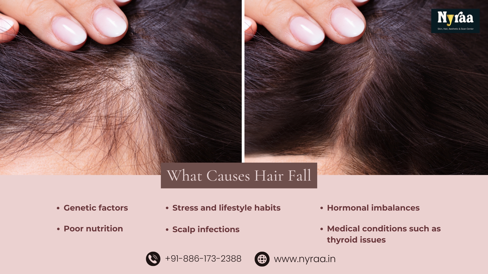 Hair Fall Treatment in Mathikere Bangalore