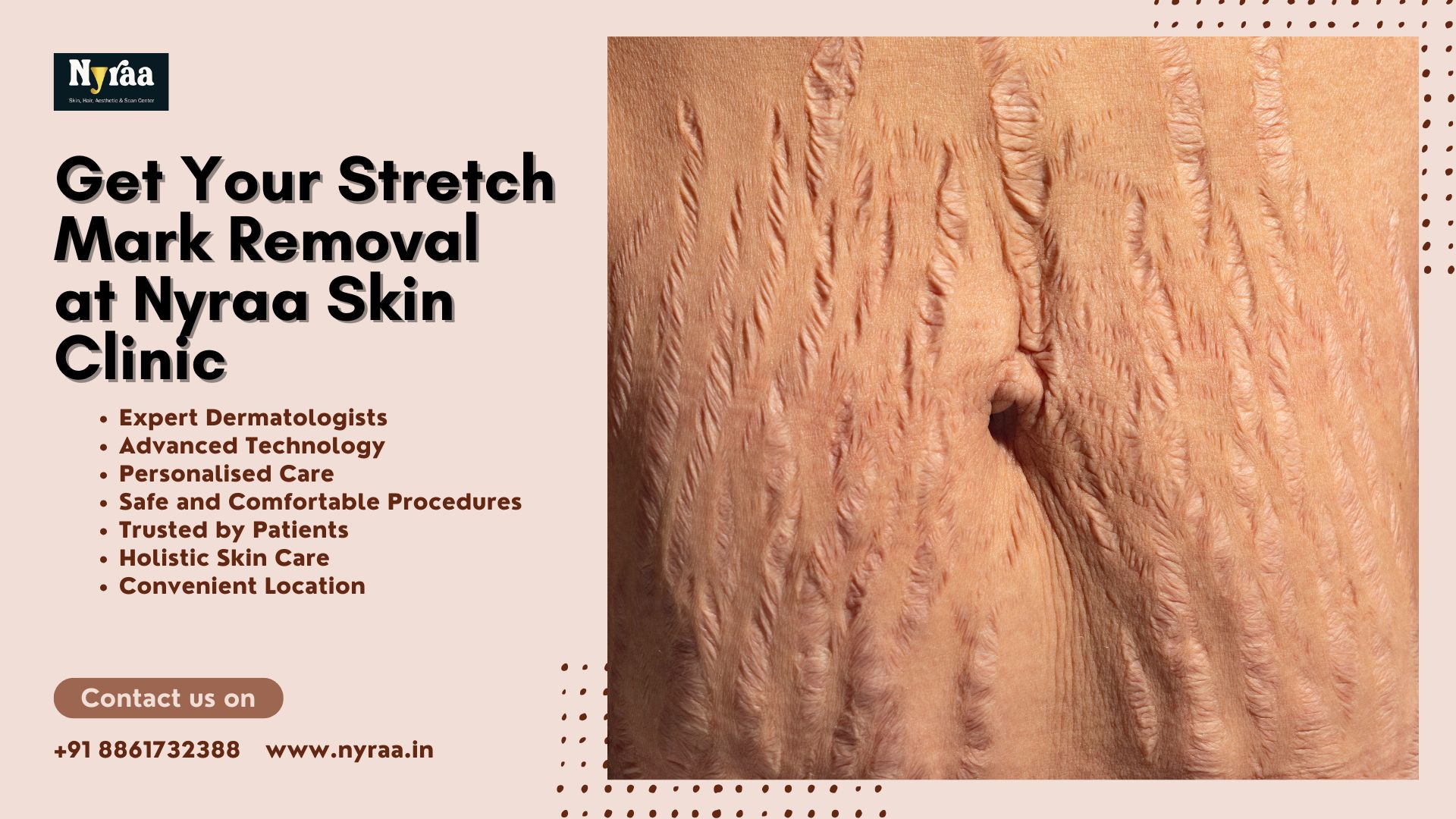 Stretch Marks Removal in CV Raman Nagar
