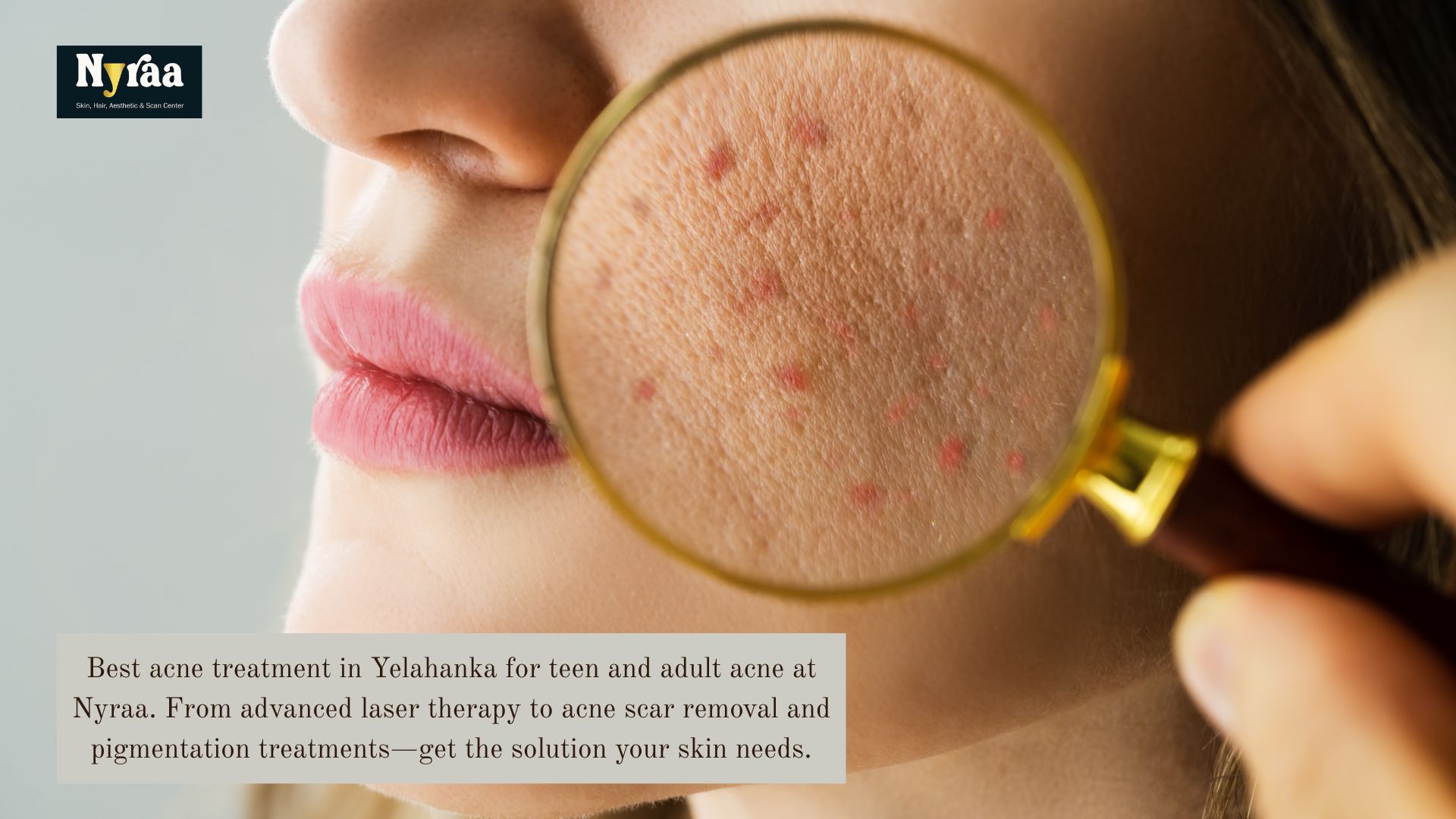 Best Acne Treatment in Yelahanka for Teen  Adult Acne