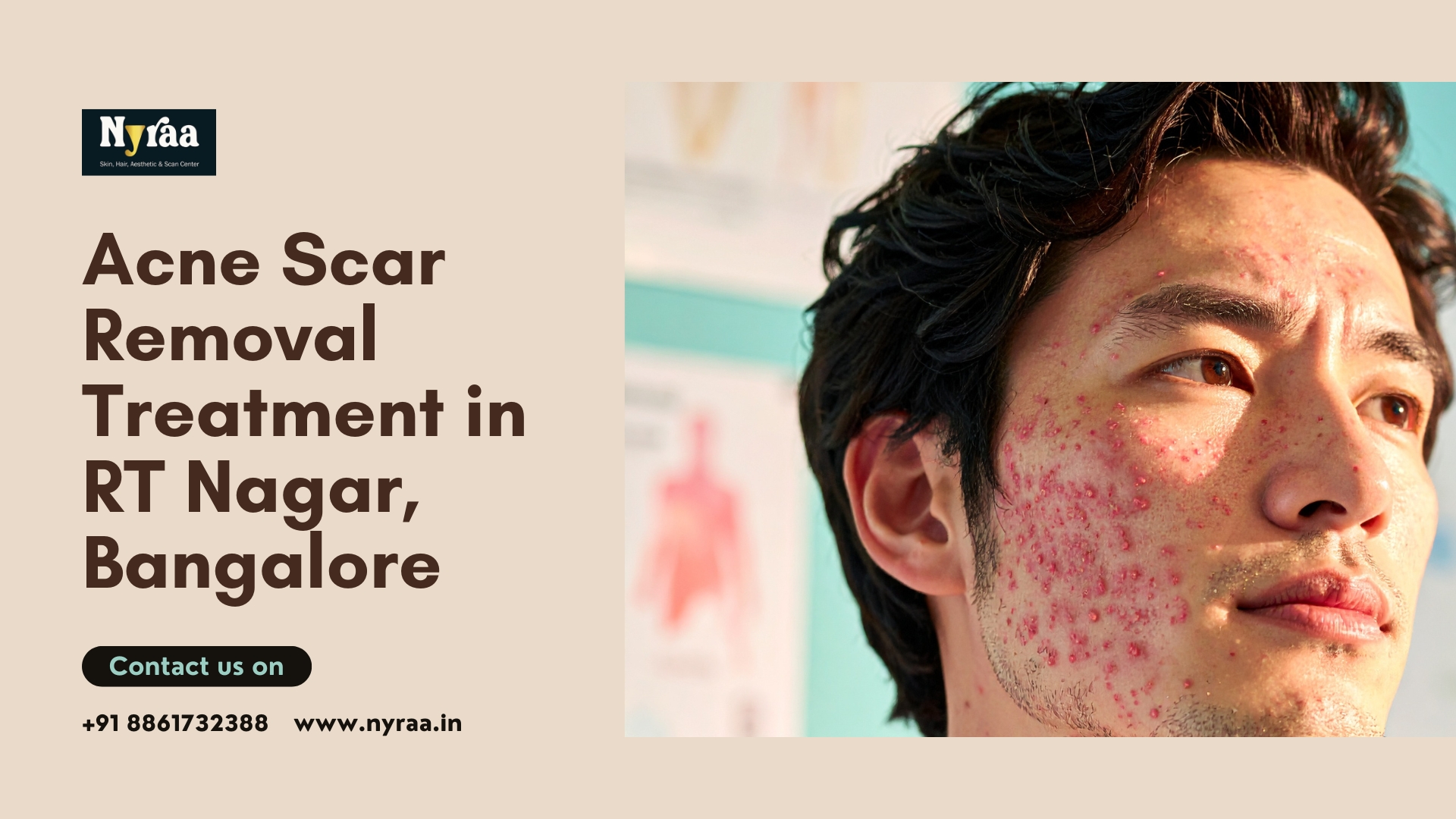 Acne Scar Removal Treatment in RT Nagar Bangalore