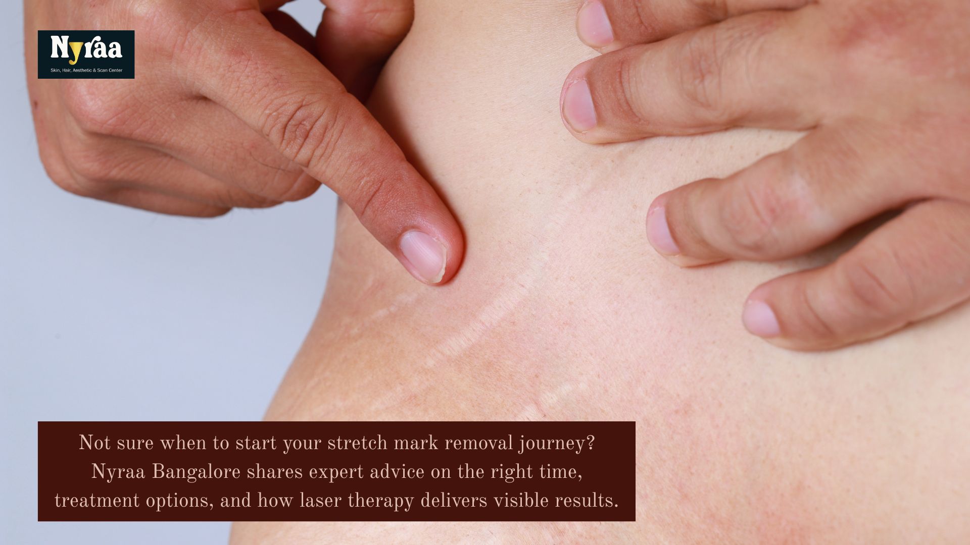 When Should You Start Stretch Mark Removal Treatments for Optimal Results