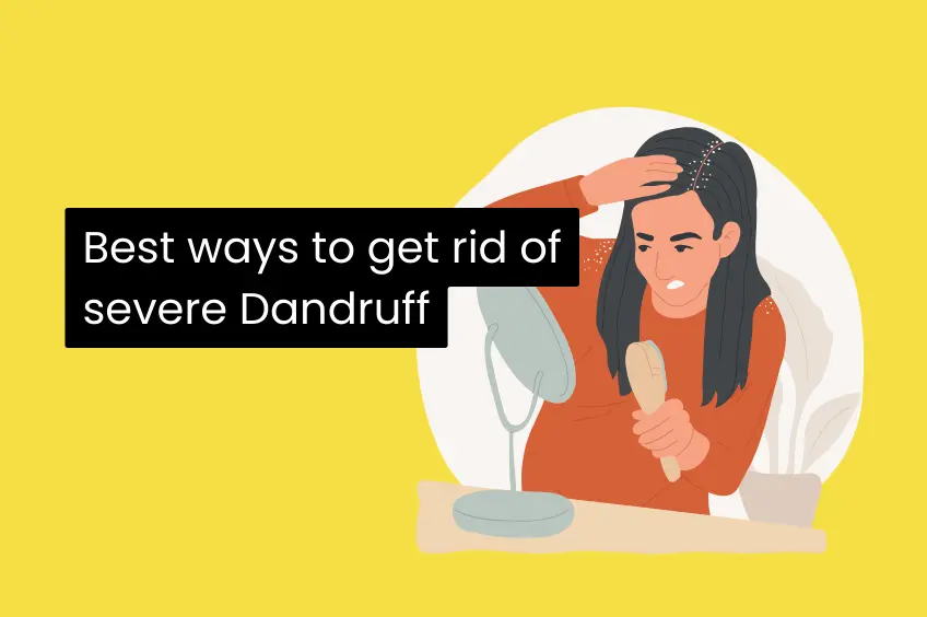 Best ways to get rid of severe Dandruff