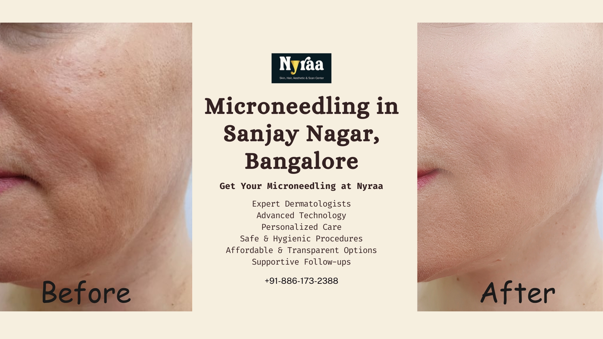 Microneedling in Sanjay Nagar Bangalore