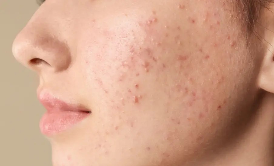 Why Do Some People Experience Adult Acne and How to Treat It