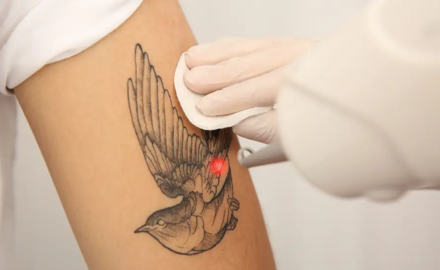 Top Benefits of Choosing Laser Treatment for Tattoo Removal