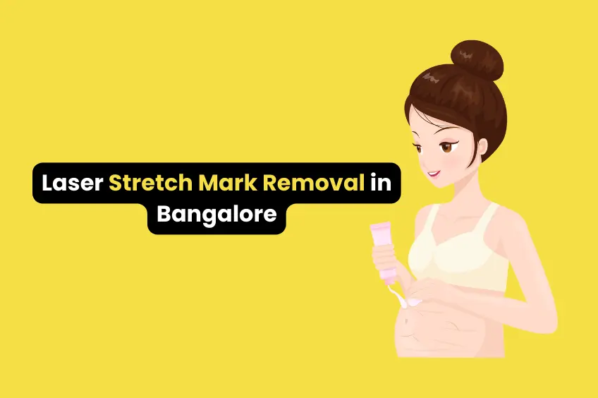 Laser Stretch Mark Removal in Bangalore