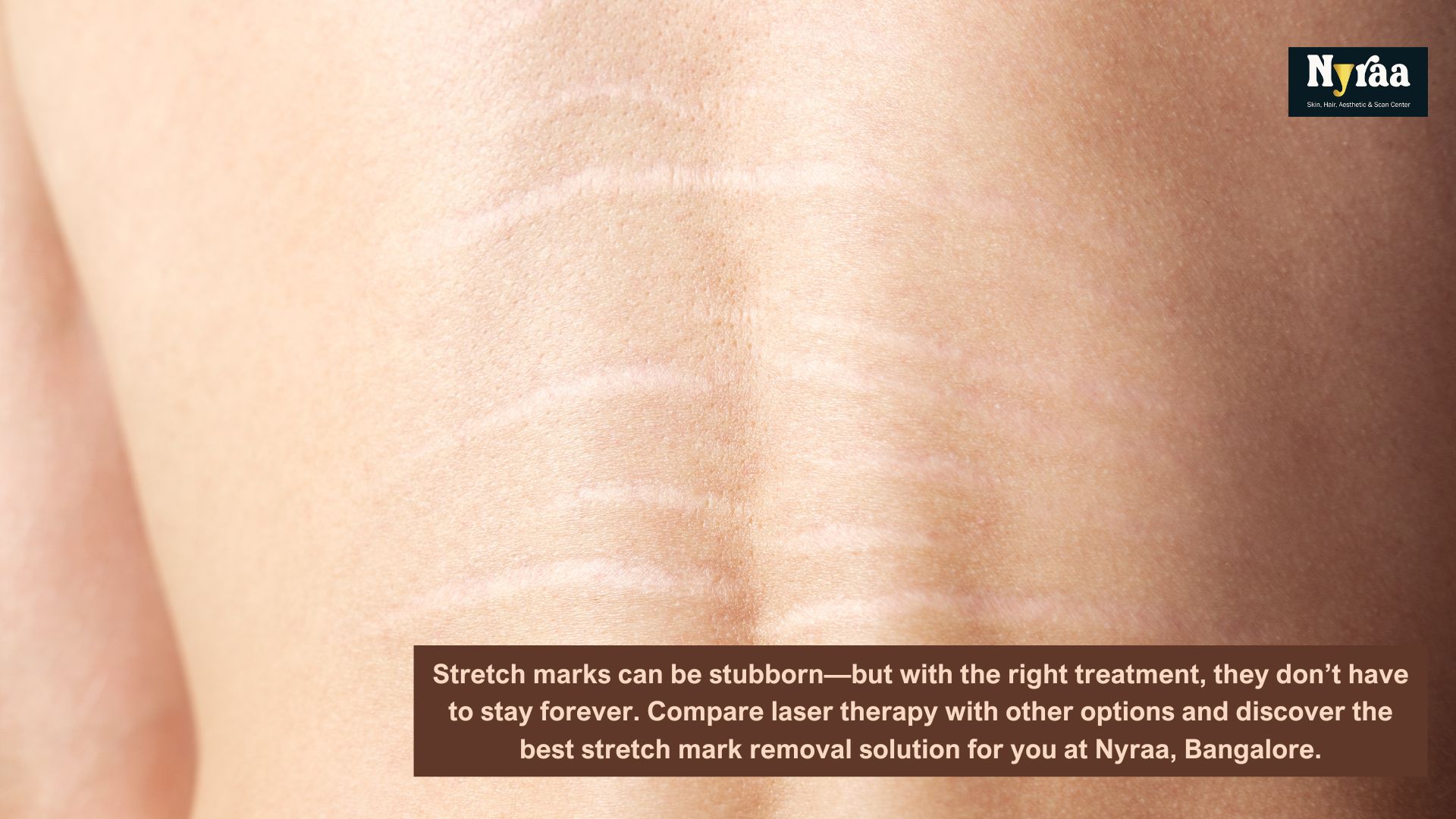 Laser Stretch Mark Removal vs Other Treatments Which is Best for You