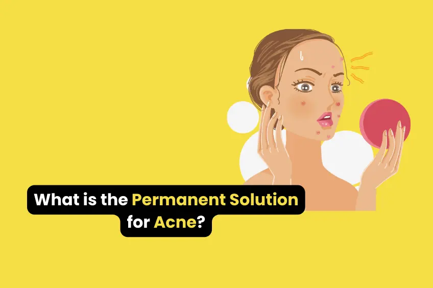 What is the Permanent Solution for Acne