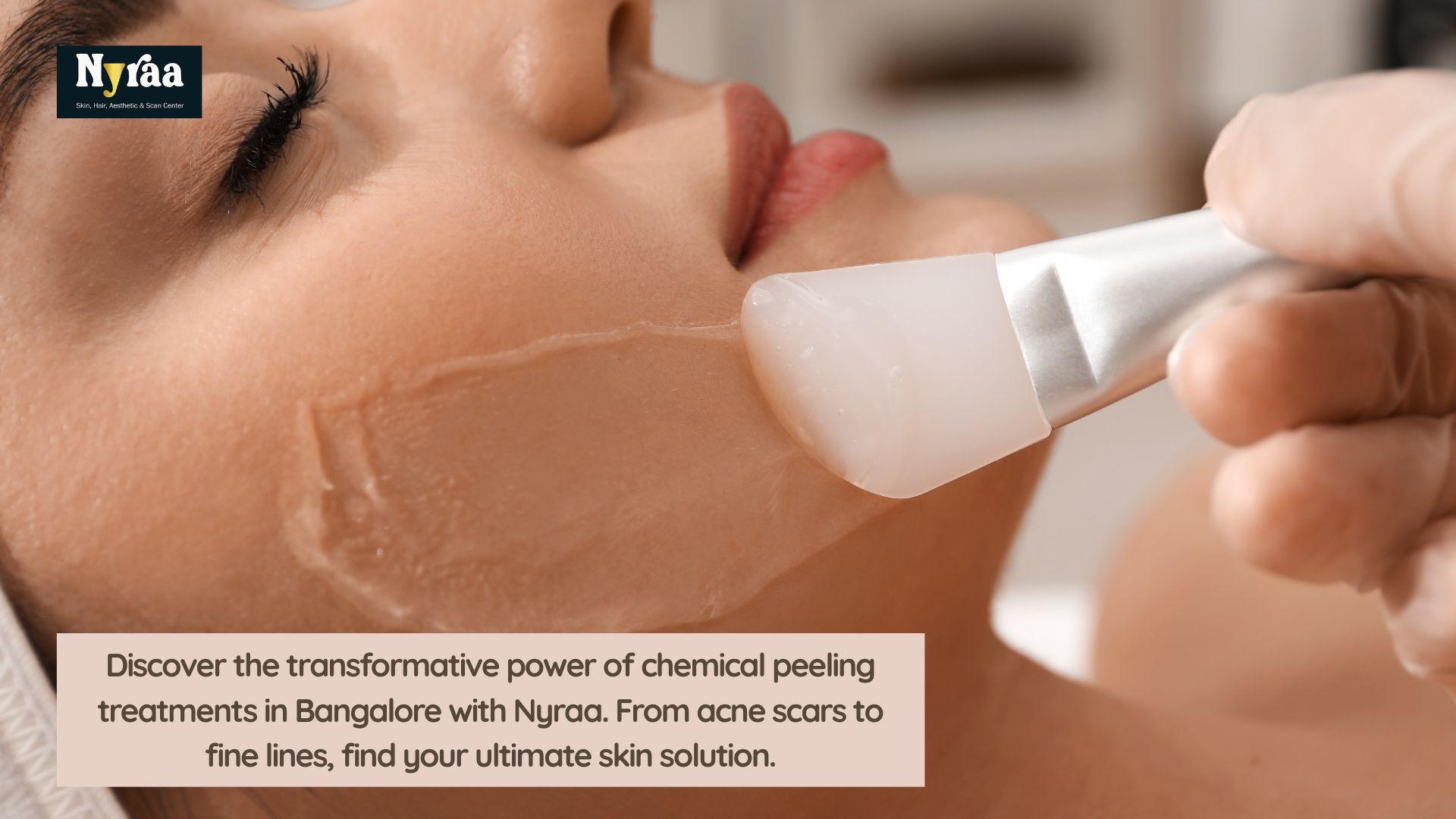 Youthful Glow with Chemical Peeling in Nagawara Bangalore