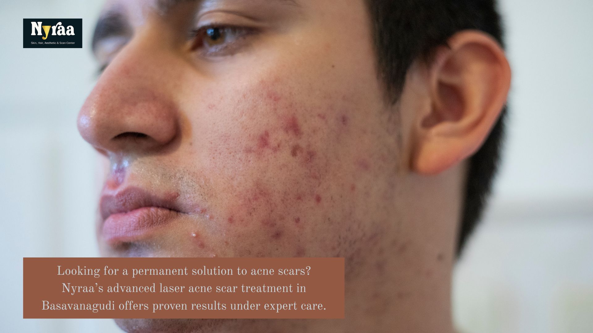 Acne Scar Laser Treatment in Basavanagudi
