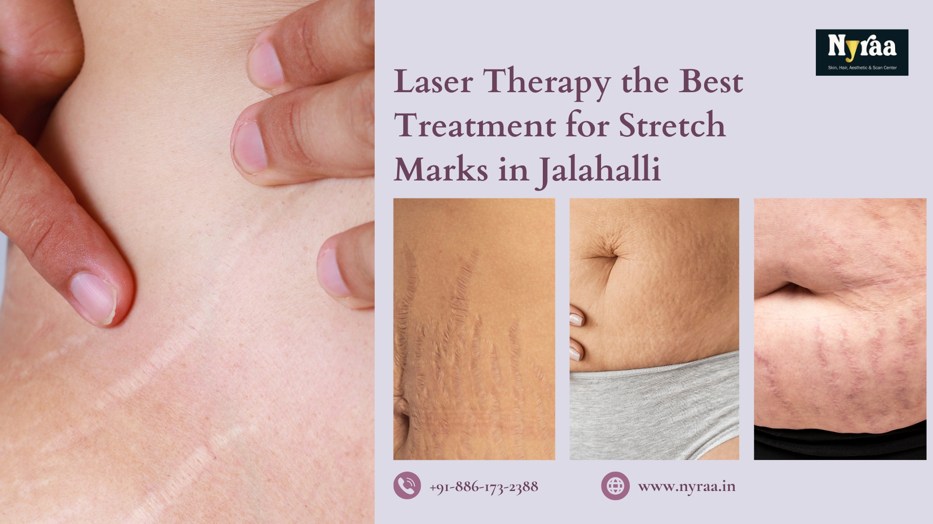 Stretch Marks Removal in Jalahalli Bangalore