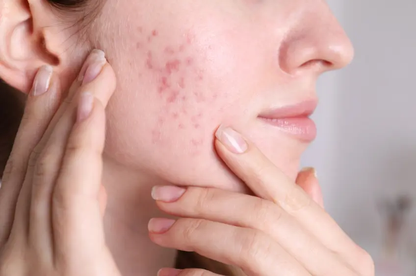 Clear Your Skin with Effective Acne Treatment in Bangalore